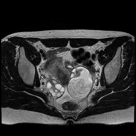 Ovarian dermoid - Body MR Case Studies - CTisus CT Scanning