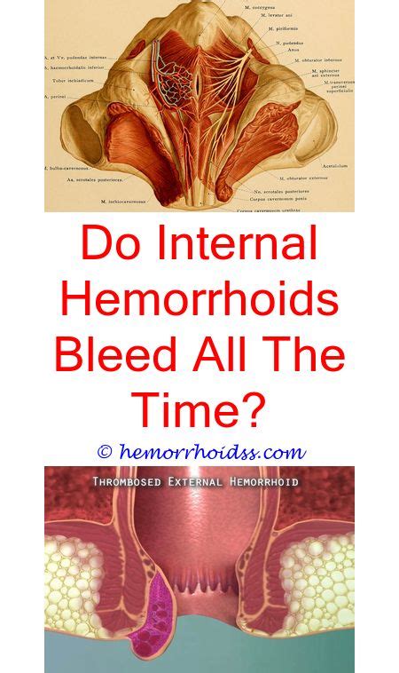 How To Relieve A Thrombosed Hemorrhoid? what if my external hemorrhoid ...