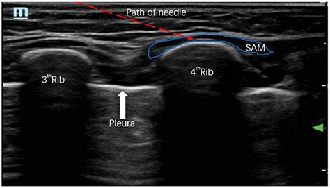 Frontiers | Case report: Ultrasound-guided bilateral serratus anterior ...