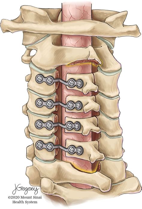 Cervical Laminoplasty