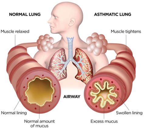 Test Quiz: Pharmacotherapy Of Asthma | Attempts: 1602 - Trivia & Questions