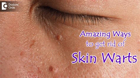 AMAZING WAYS TO GET RID OF SKIN WARTS | Skin Wart Removal Tips - Dr ...