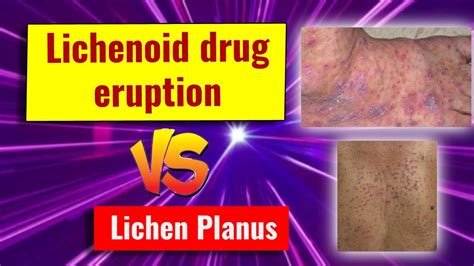 Lichenoid drug eruption: features and comparison with lichen planus ...