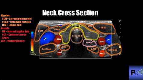 Normal Thyroid Appearance And Anatomic Landmarks In Neck Ultrasound