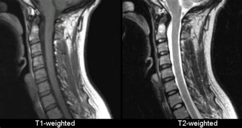 Cervical Spine Mri Comparison