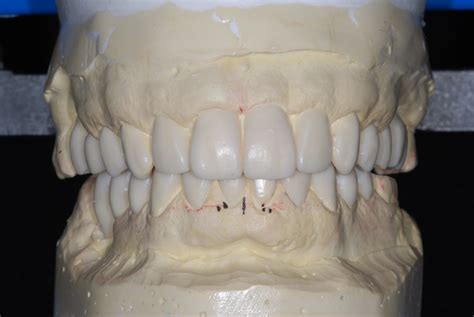 Diagnostic Wax Up