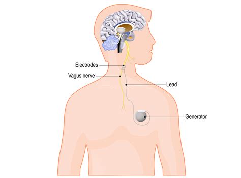 Vagus Nerve Stimulation Side Effects