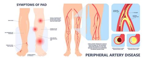 Peripheral Artery Disease | What You Need To Know - Page 4 of 8 ...