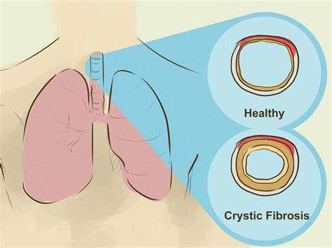 How to Diagnose Lung Hyperinflation: 10 Steps (with Pictures)