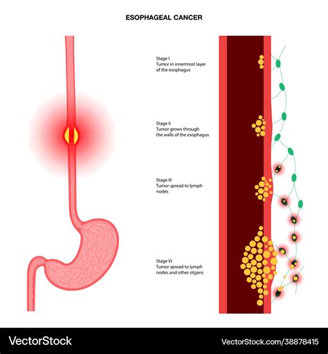 Esophageal cancer stages Royalty Free Vector Image