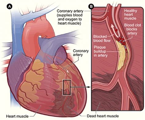 Unstable angina causes, symptoms, diagnosis & unstable angina treatment