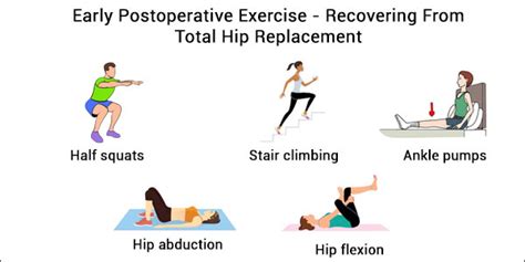 Total Hip Replacement Surgery – Early Postoperative Exercise To ...