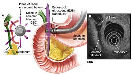 Endoscopic Ultrasconography Rectum/Colon (EUS)