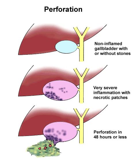 Symptoms: Symptoms Of Gallbladder