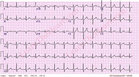 Normal 12-lead ECG tracing | LearntheHeart.com