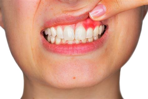 Home Remedies Against Inflamed Gums: 5 Practical Tips!