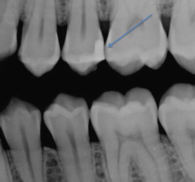 What Do Cavities Look Like On X Ray