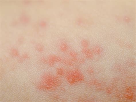 Eczema Symptoms and Causes | Styles At Life