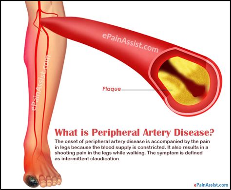 What is Peripheral Artery Disease|Causes|Signs|Symptoms|Diagnosis