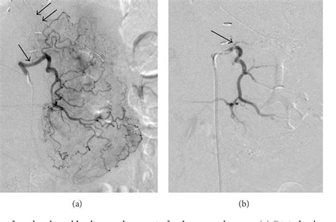 Structure of left gastric artery | Semantic Scholar