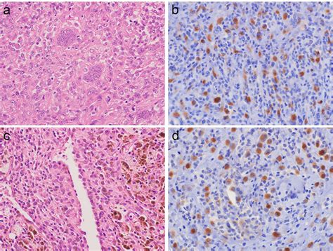 Histology and CSF1 IHC of TSGCTs. a. LTSGCT showed a well-circumscribed ...