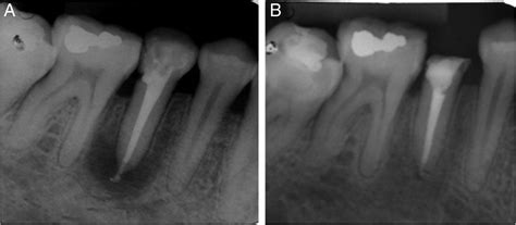 Acute Apical Abscess Radiograph