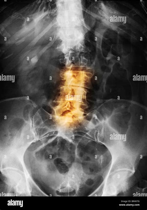 Lumbar spine x-ray of a 79 year old woman with degenerative arthritis ...