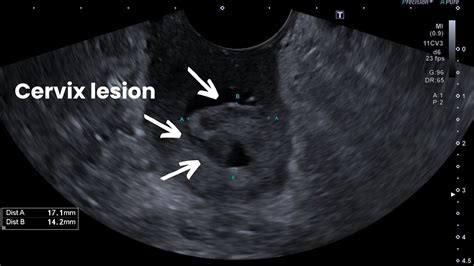 Transvaginal Ultrasound showing large cervical polyp / cervix mass ...