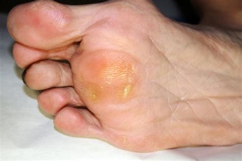 Foot Corn Removal Remedies – Foot Care Tips