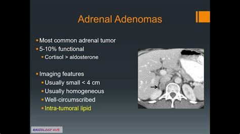 Adrenal Adenomas Radiology Lecture | Types | CT MRI Features | Absolute ...