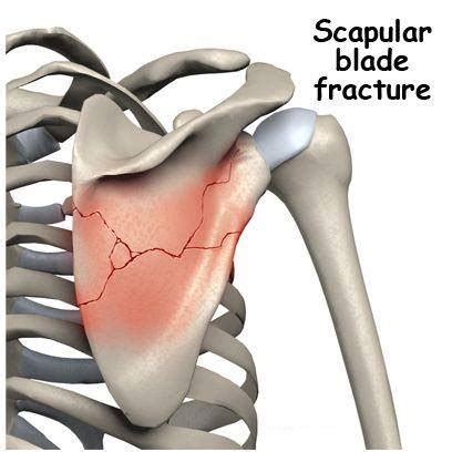 amudu: SCAPULAR BLADE FRACTURE