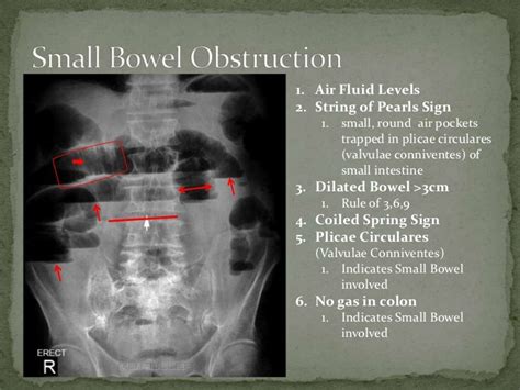 Small bowel obstruction (1)