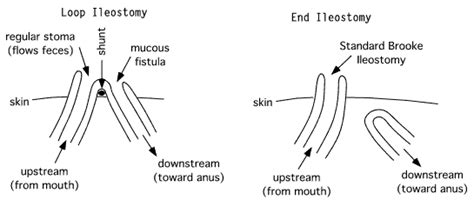 Loop Ileostomy | www.pixshark.com - Images Galleries With A Bite!