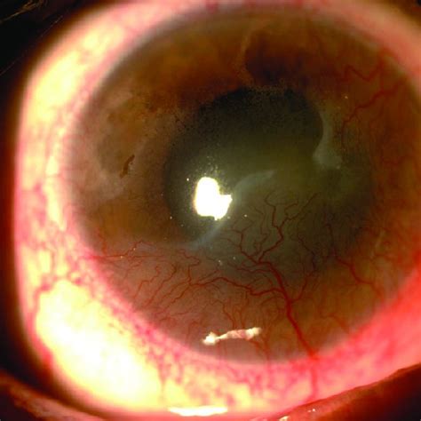 Corneal foreign body. | Download Scientific Diagram