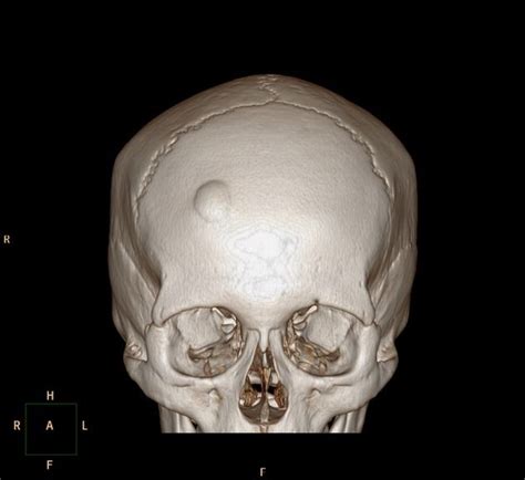 Osteoma | Radiology Reference Article | Radiopaedia.org | Radiology ...