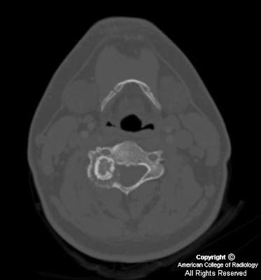 Neuroradiology On the Net: Osteoblastoma