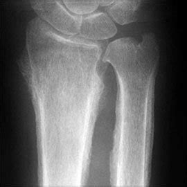 Periostitis - Causes, Symptoms, Treatment and Complications