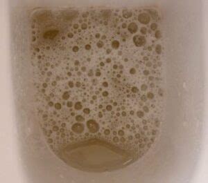 Cloudy Urine Causes in the Morning, Diabetes, Smelly in Pregnancy, Men ...