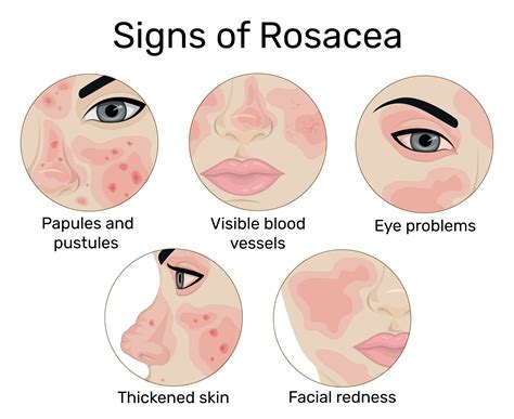 Causes Of Rosacea Flare Ups