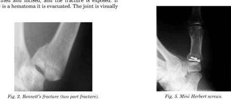 Figure 4 from Operative treatment of Bennett's fracture. | Semantic Scholar