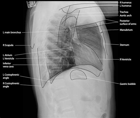 Normal Chest X-Ray • LITFL Medical Blog • Labelled Radiology