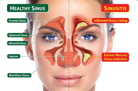 Sinus Headache - Causes, Symptoms, Relief & Treatment