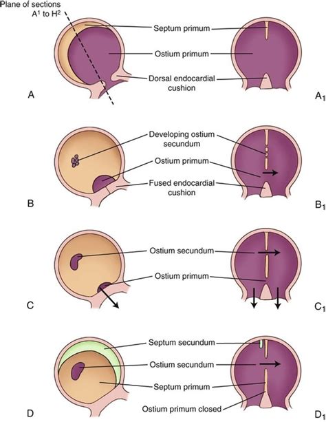 Atrial Septal Defect Anatomy