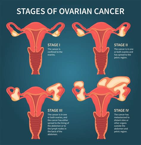 Stages of womans ovarian cancer dark blue scheme 3238421 Vector Art at ...