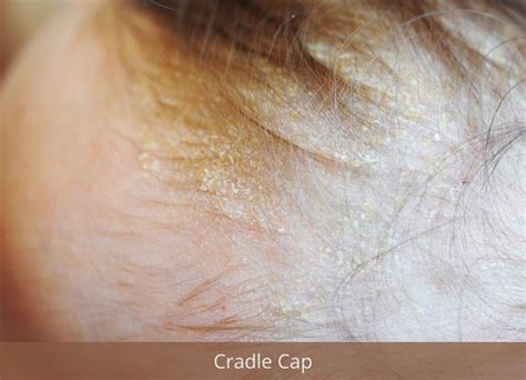 Cradle Cap In Adults? Seborrhoea: Everything You Need To