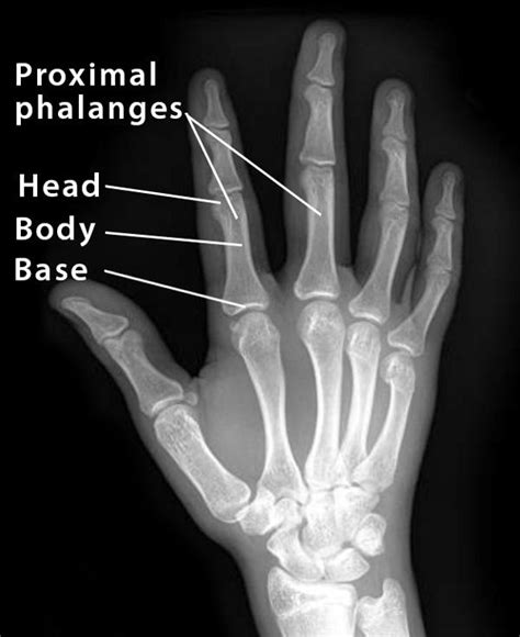 Proximal Phalanx: Definition, Location, Anatomy, Diagram