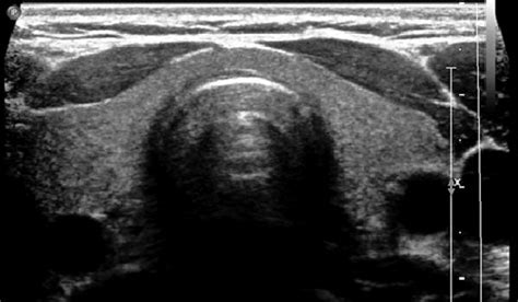 Thyroid Ultrasound Measurements