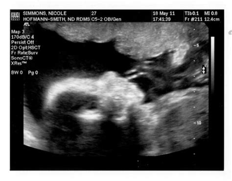 23 week ultrasound | nicole simmons | Flickr