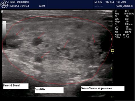 Viral Parotitis : POCUS Blog