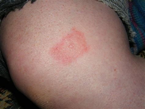 How To Identify And Treat The Most Common Bug Bites - Simplemost